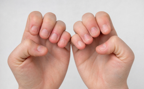 Deux mains présentant des ongles très courts et rongés.